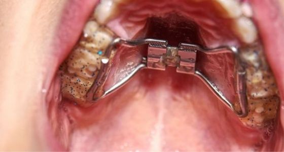 What is palate expander
