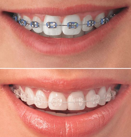 What Is The Cost For Invisalign Treatment At Mellion Orthodontics