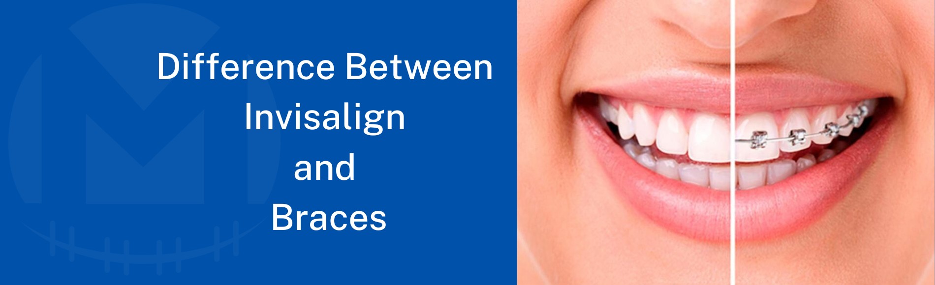 Difference Between Invisalign and Braces : Which Is Better?