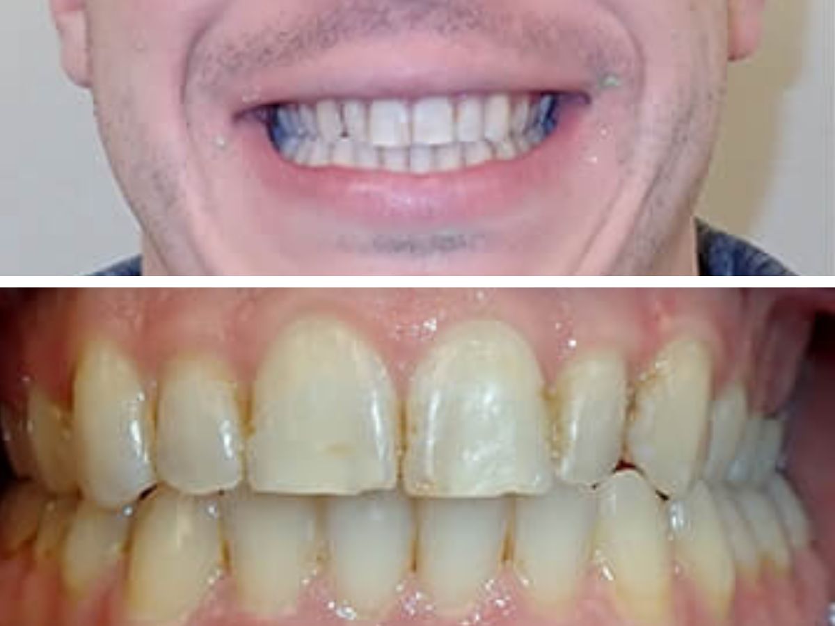 after-using-braces-on-adults