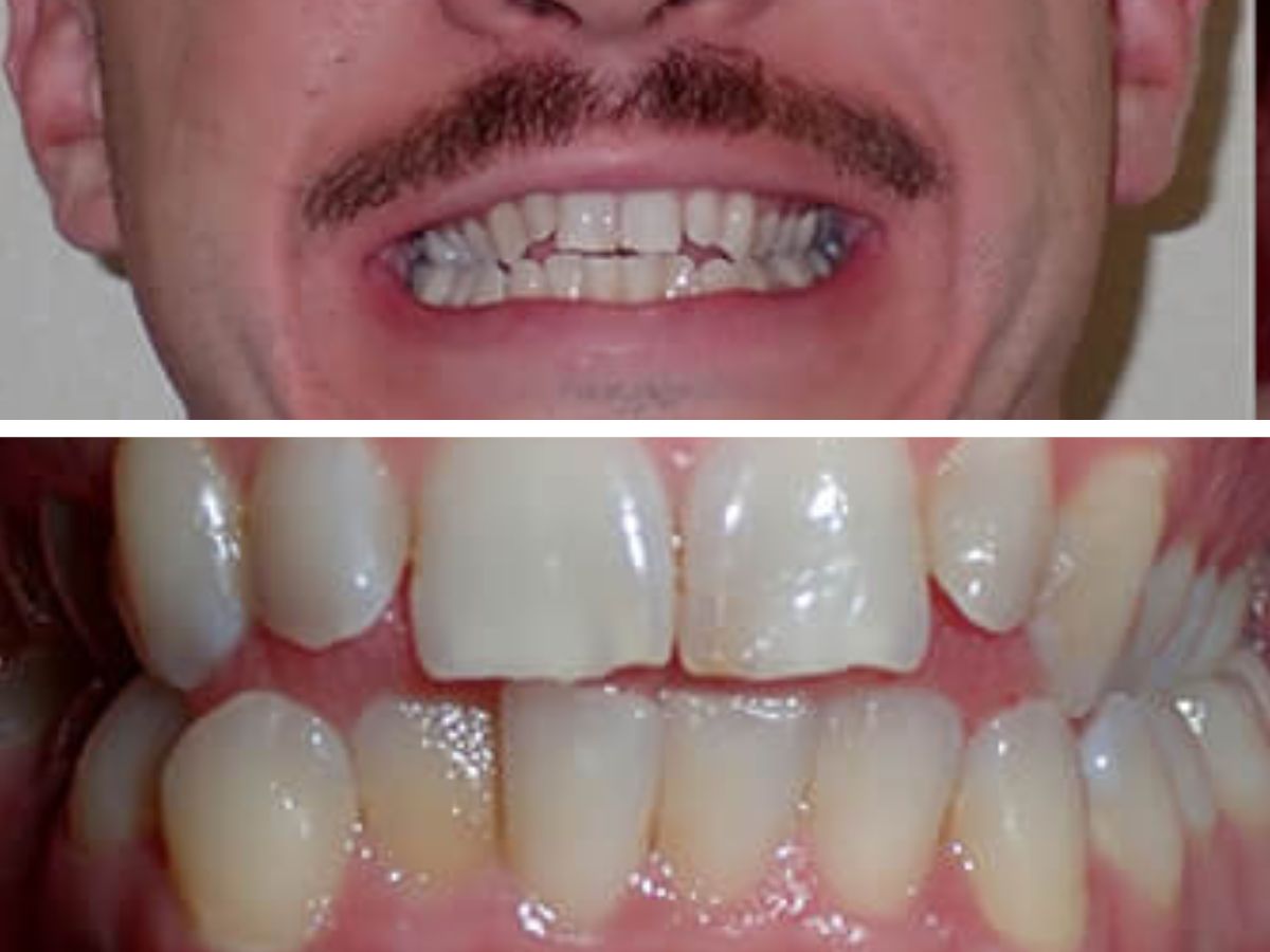 before-using-braces-on-adults