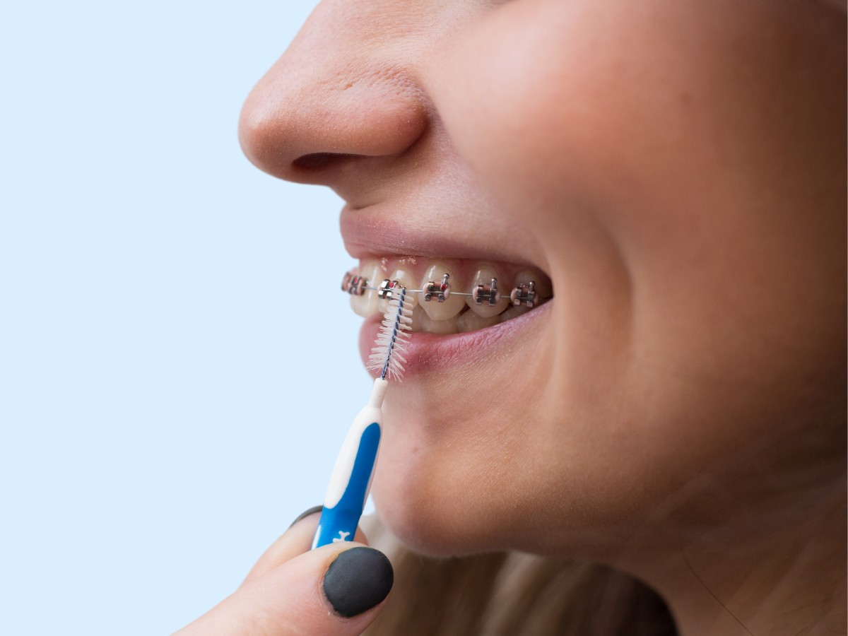 how-long-will-i-have-to-wear-braces-or-invisalign-aligners