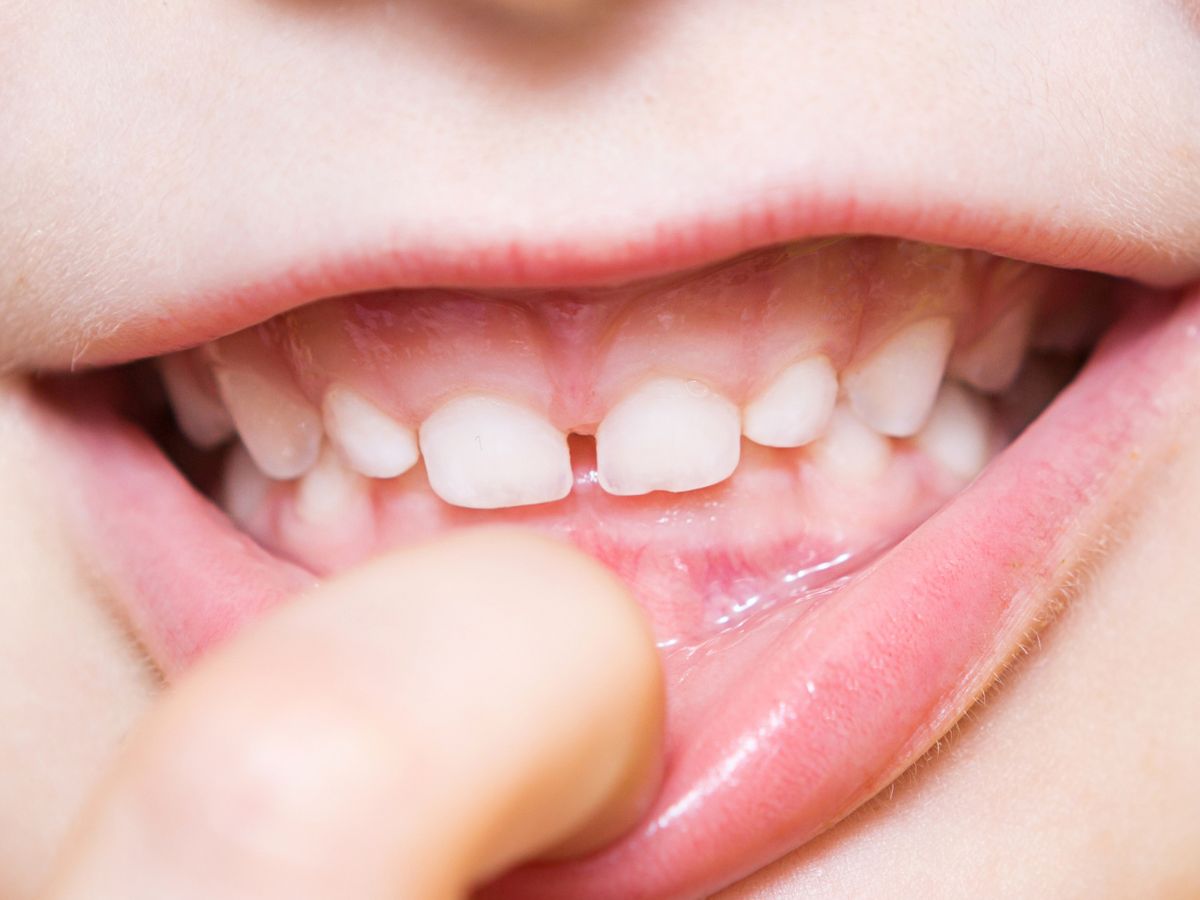 overbite -teeth