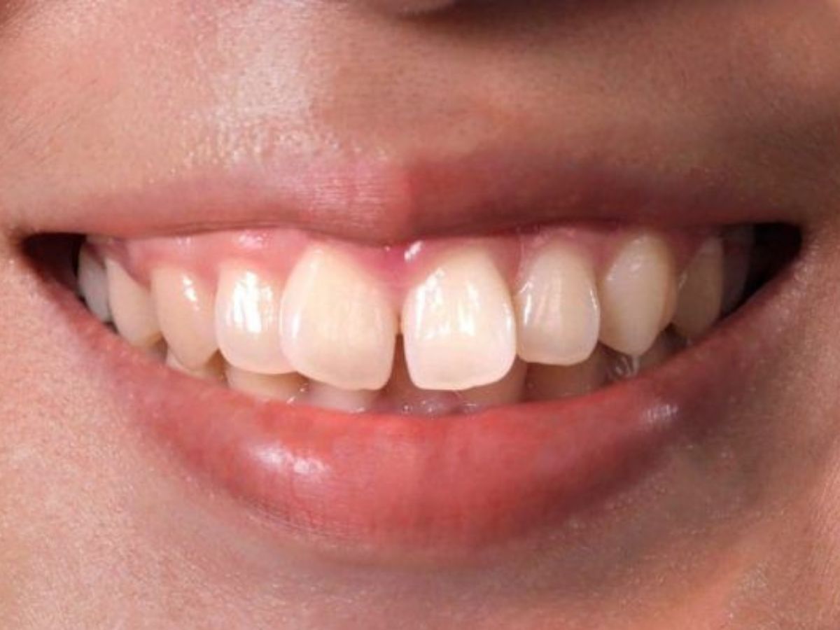 protruding-teeth