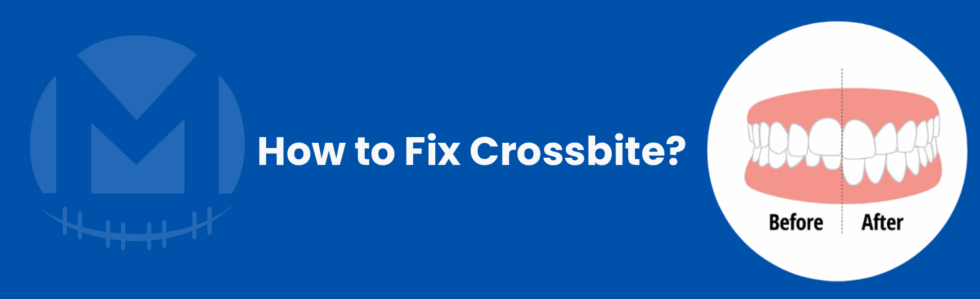 Crossbite Mask How to Fix Crossbite: Treatment Options That Really Work | Mellion ...