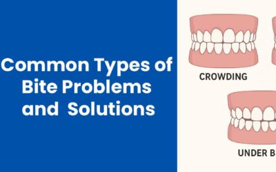 5 Common Types of Bite Problems and Their Orthodontic Solutions