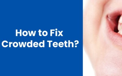 How to Fix Crowded Teeth: A Comprehensive Guide to Treatment Options