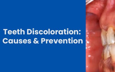Teeth Discoloration: Causes, Types, and Prevention Tips