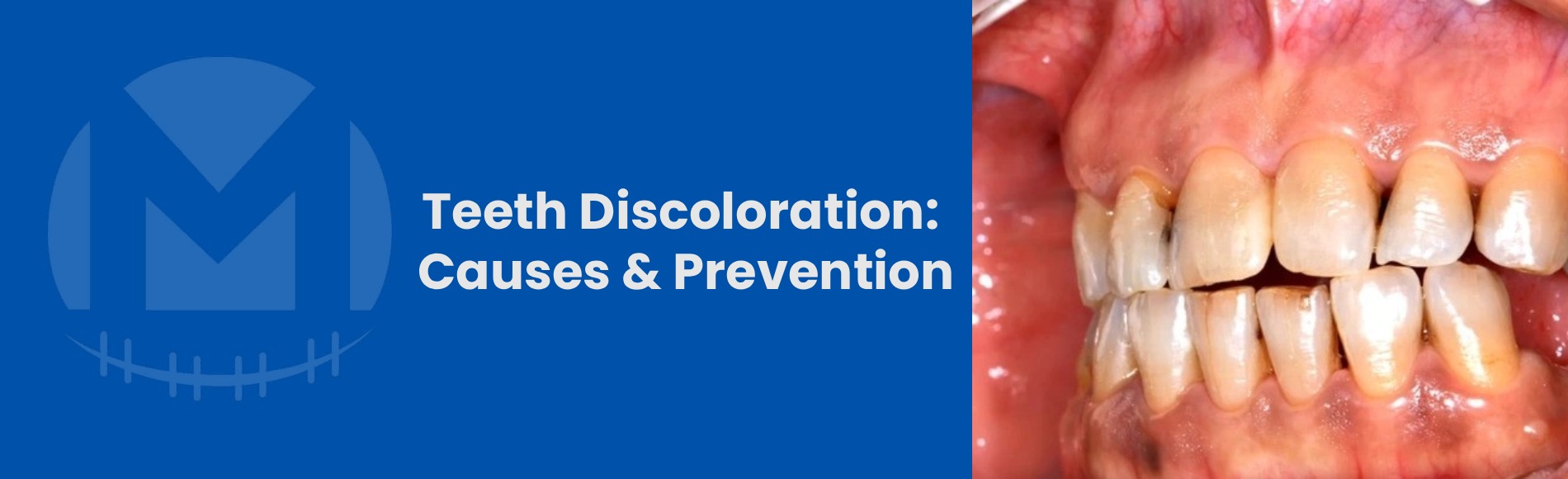 Teeth Discoloration: Causes, Types, and Prevention Tips
