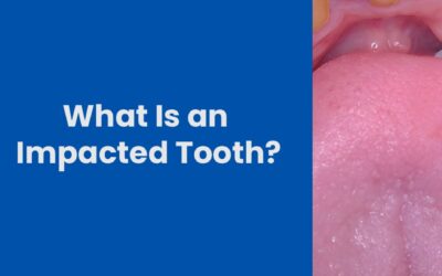What Is an Impacted Tooth? Signs You Should Not Ignore