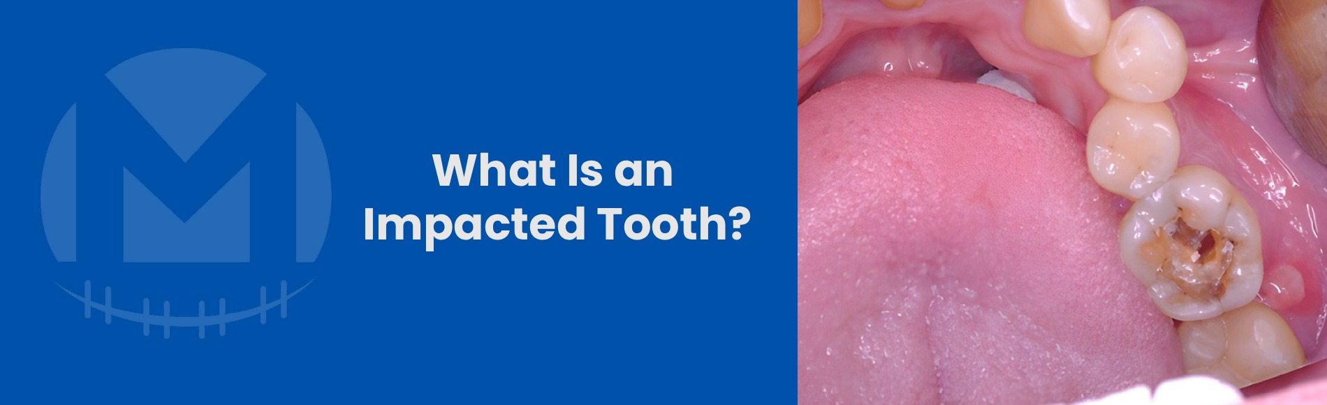 What Is an Impacted Tooth? Signs You Should Not Ignore